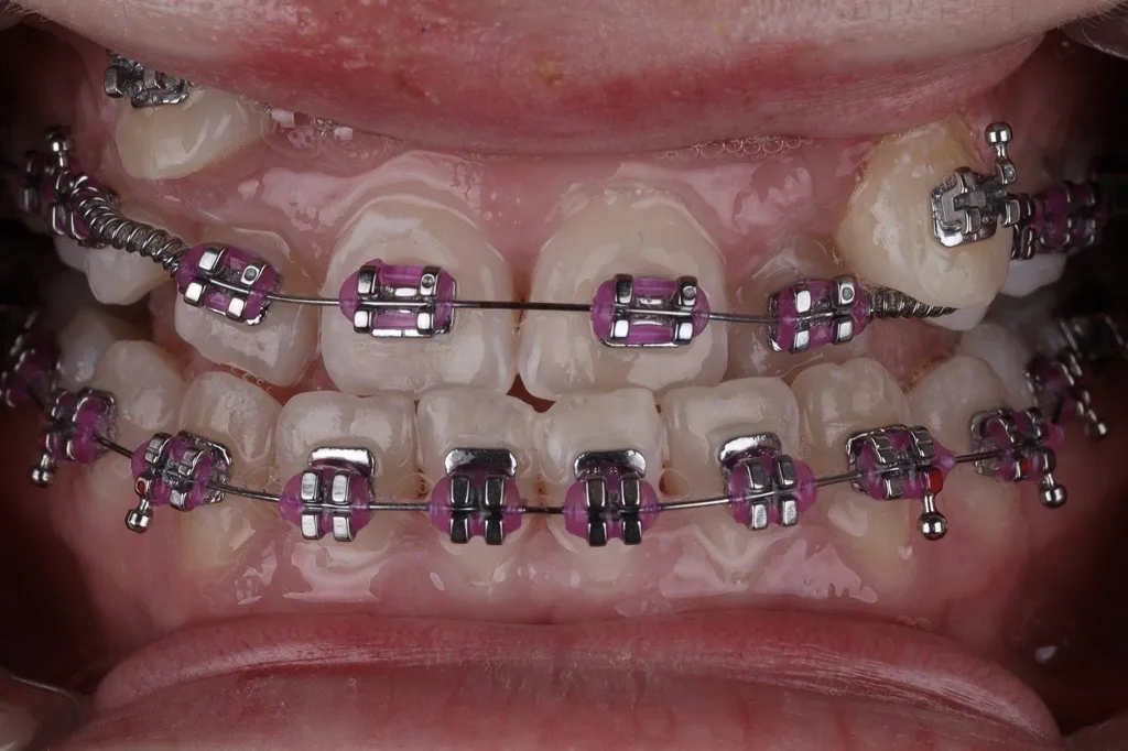 Ortodontski aparati – sve što trebate znati