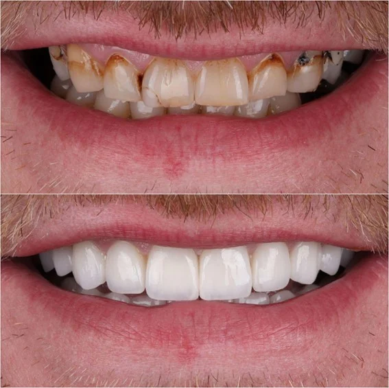 Kandidati za Hollywood smile tretman