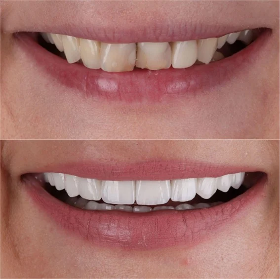 Viniri i luminiri za Hollywood smile