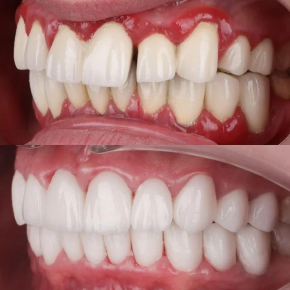 How to Prevent Bleeding Gums? Saraj Dent Tips